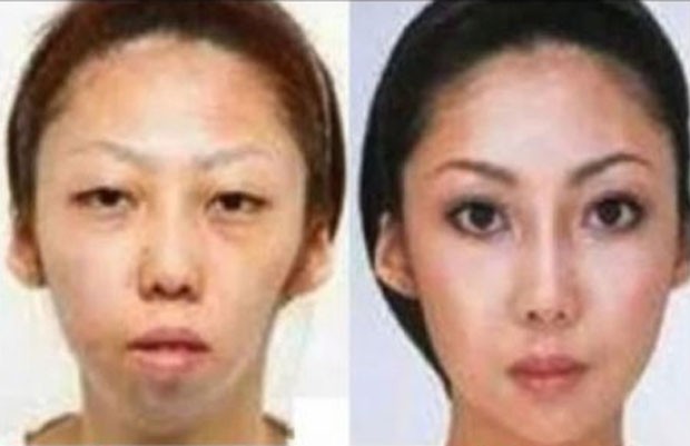 Chinês Processa Esposa Por Cirurgia Pra Ficar Bonita